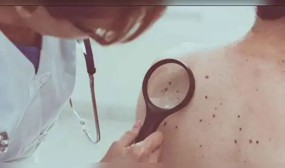 Iniciativa “Por un Perú Sin Cáncer” lanza campaña para alertar de los peligros de la radiación ultravioleta y el cáncer de piel