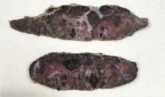 El coronavirus destruyó la placenta de mujeres infectadas y mató a sus bebés