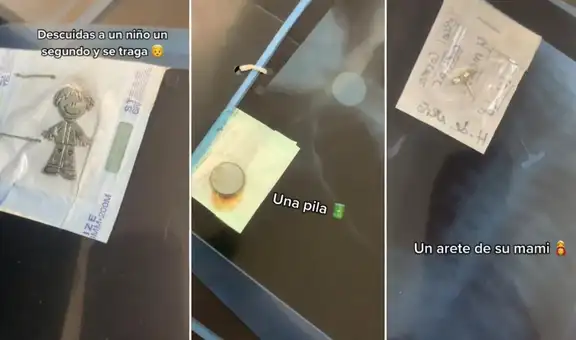 Radiografías muestran los peculiares objetos que los niños suelen comer por accidente