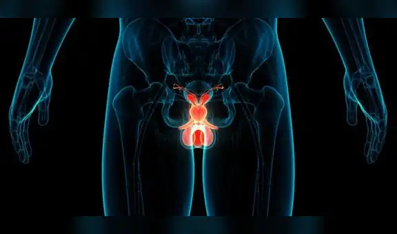 Uno de cada siete hombres padece cáncer de próstata 