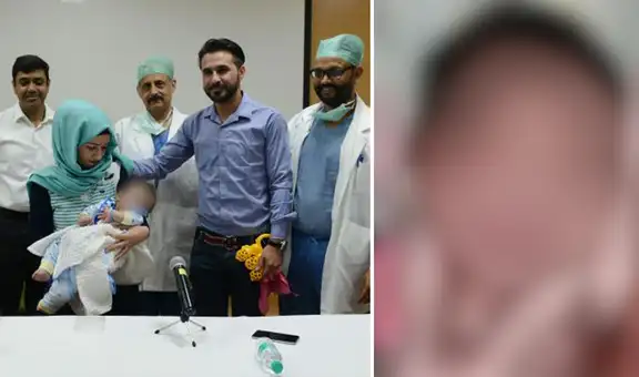 Nace bebé con 4 piernas y 4 brazos en la India: lo consideran un “milagro de la naturaleza”