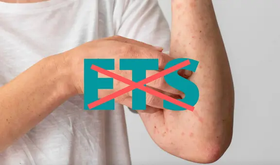 ¿Por qué la viruela de mono no es una ETS ni una enfermedad exclusiva de la comunidad LGTB?