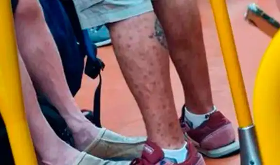 “Sí, tengo eso”: captan a pasajero infectado con viruela del mono y le exigen que haga cuarentena