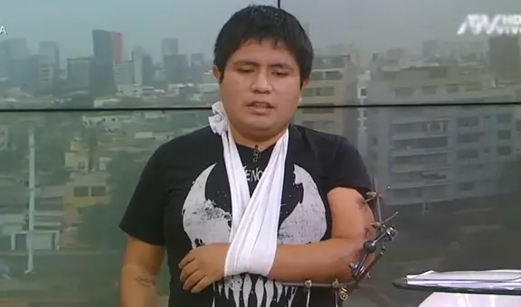 “Me iban a dormir, jalar el brazo y poner un clavo”: joven denuncia negligencia tras operación por fractura