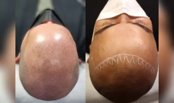 Micropigmentación capilar, una alternativa para la alopecia