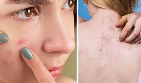 ¿Por qué no se deben reventar las espinillas y granos de la cara y espalda?