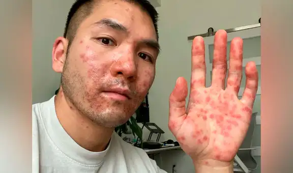 Le diagnostican sarna y herpes por error, pero en realidad tenía la viruela del mono