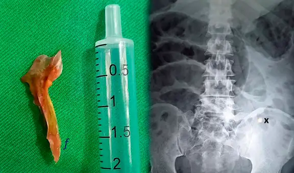 Hombre muere luego de comerse accidentalmente una espina de pescado de 2 cm de largo