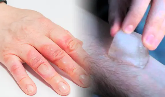 ¿Por qué no debo poner hielo en la piel si sufrí una quemadura y qué puedo colocar?
