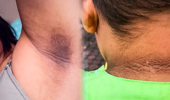 ¿Cómo eliminar las manchas oscuras en el cuello, axilas o entrepierna, y por qué aparecen?