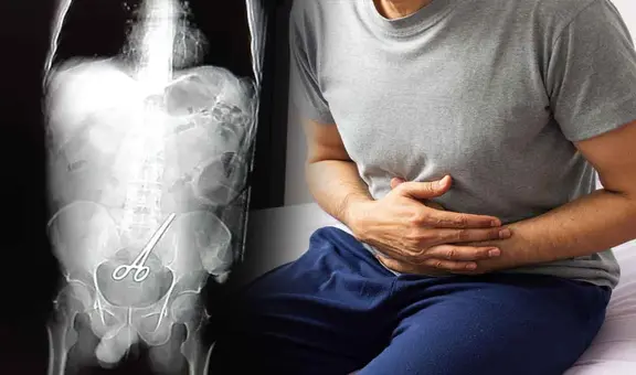Hombre acude al hospital por dolor abdominal y encuentran tijeras quirúrgicas en su intestino