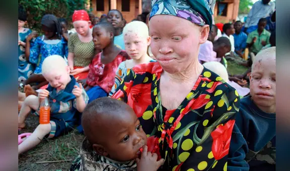 Vivir con miedo: niños y adultos albinos en África son asesinados para el tráfico de órganos