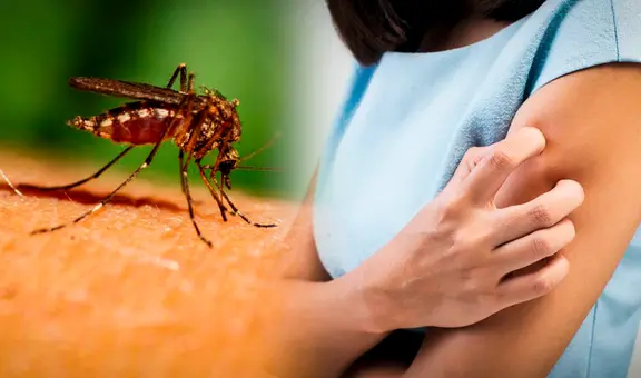 ¿Cómo quitar la picazón de un mosquito con remedios caseros?