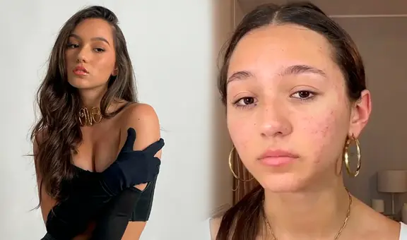 Alexia Barnechea se quiebra al revelar el severo acné que padece: “Voy a cuidar de mí”