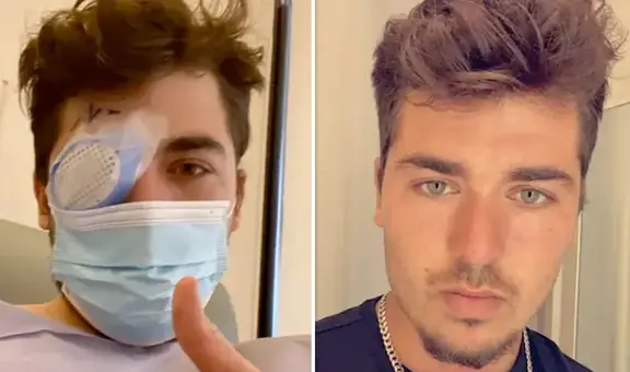 Joven durmió con los lentes de contacto puestos y un parásito se comió su ojo: Fue un dolor inexplicable