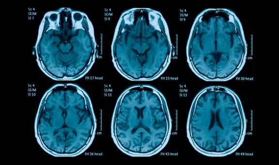 Impactante: estudio revela cuántos años envejece el cerebro tras una noche sin dormir