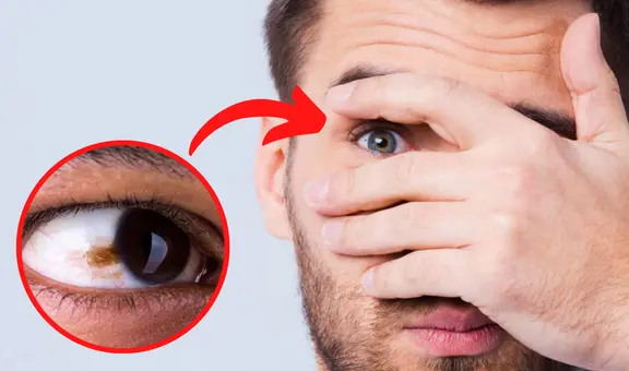 ¿Por qué aparecen lunares en los ojos, qué significan y cuándo deben ser eliminados?