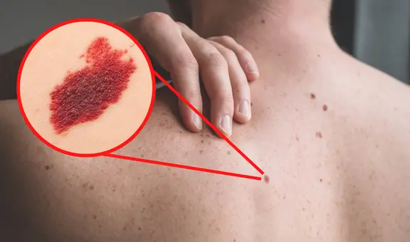 ¿Por qué algunas personas tienen lunares de sangre y qué tan peligrosos son?