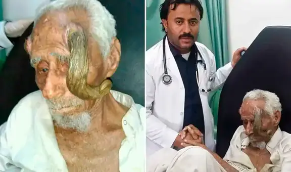 El trágico final del 'Hombre cabra': familia denuncia que murió tras extraerse sus 'cuernos'