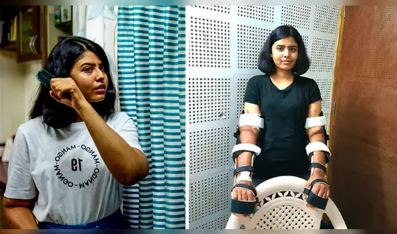 El increíble caso de la mujer que recibió un trasplante de brazos de un hombre y su cuerpo logró adaptarlos