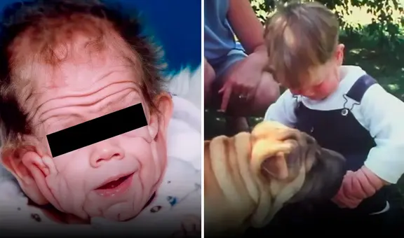 El increíble caso de Tomm Tennent, el bebé que nació con un alarmante exceso de piel
