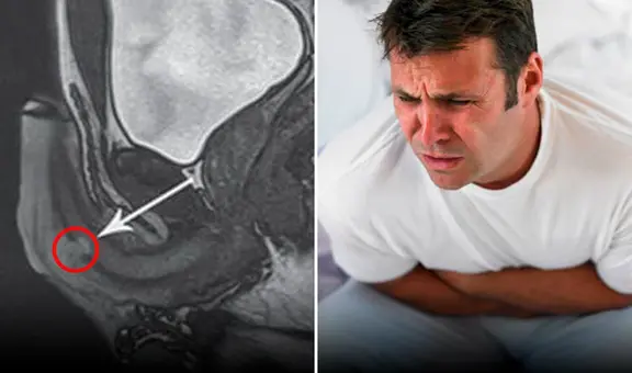 Hombre se fracturó el pene mientras practicaba la pose sexual ‘más peligrosa del mundo’