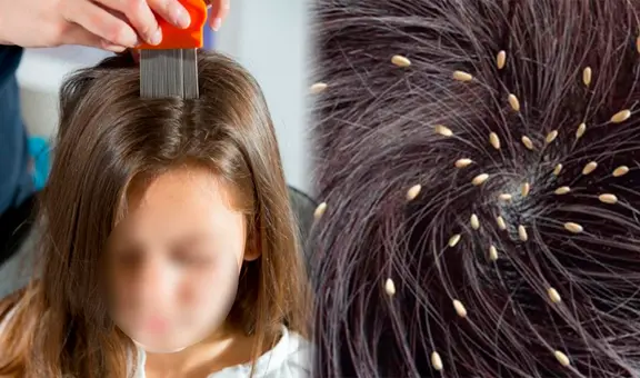 ¿Por qué algunos menores siempre tienen piojos, mientras que otros no, y cómo eliminarlos del cabello?