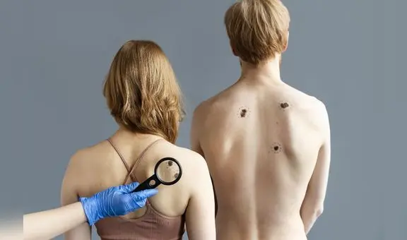 Riesgo de cáncer de piel se incrementa debido a las altas temperaturas en el norte