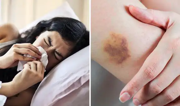 Tenía dolor de garganta, le diagnosticaron amigdalitis, pero descubre que sufre de leucemia