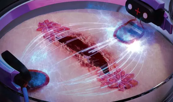 Innovadora técnica logra que las heridas sanen hasta 3 veces más rápido