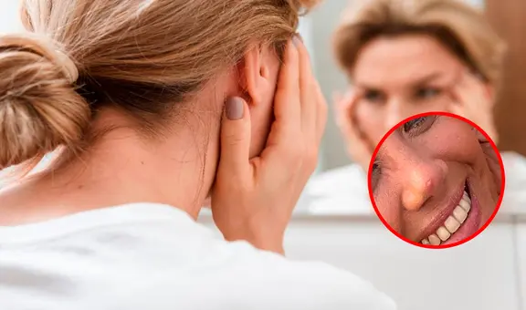 Mujer en Nueva Zelanda descubre que tenía cáncer tras reventarse un grano: “Estaba en negación”