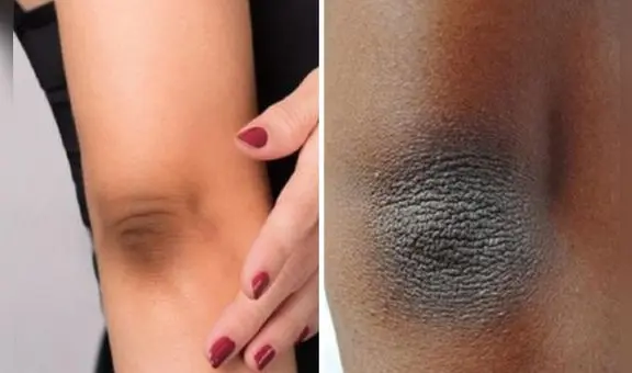 El motivo por el que se te oscurecen los codos y la forma de limpiarlos