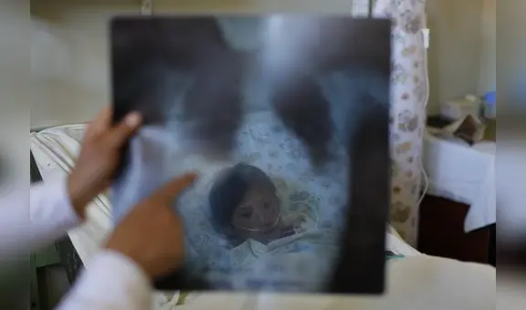 Piura registra 30 fallecidos por neumonía en lo que va el 2023