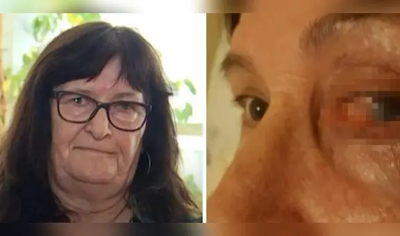 Domi, la mujer que pasó más de 50 años con una piedra en el ojo y nadie le creyó