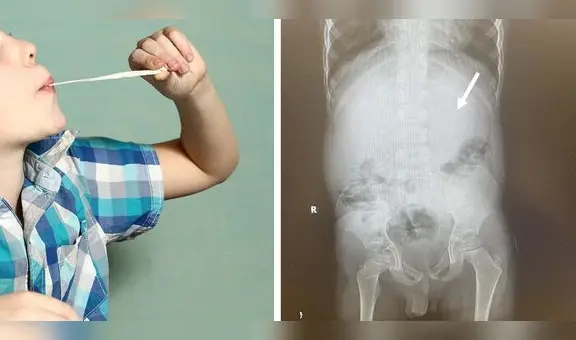 Niño tuvo que ser operado en EE. UU. tras tragarse 40 chicles y obstruir su sistema digestivo