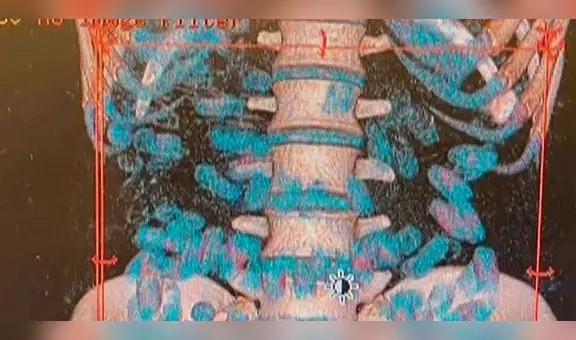 Aeropuerto Jorge Chávez: detienen a 2 sujetos que trasladaban droga en maleta y en el estómago