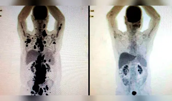 El antes y después de un paciente con cáncer que recibió prometedora terapia de células