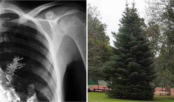 Fue al hospital por dolor de pecho y médicos hallaron parte de un árbol creciendo en su pulmón