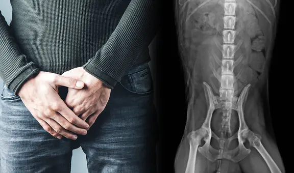 ¿Por qué los hombres son más vulnerables al cáncer que las mujeres? Estudio halla la causa