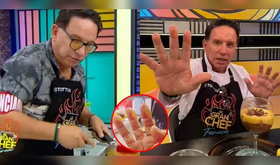 Así quedaron las manos de Ricardo Rondón tras quemaduras en "El gran chef": "Soy duro de matar"