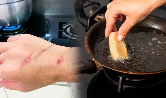 ¿Las quemaduras con aceite dejan cicatrices? Conoce cómo tratar estas heridas