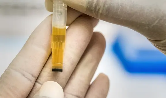 ¿Qué significa el color de la orina y en qué casos representa una infección?