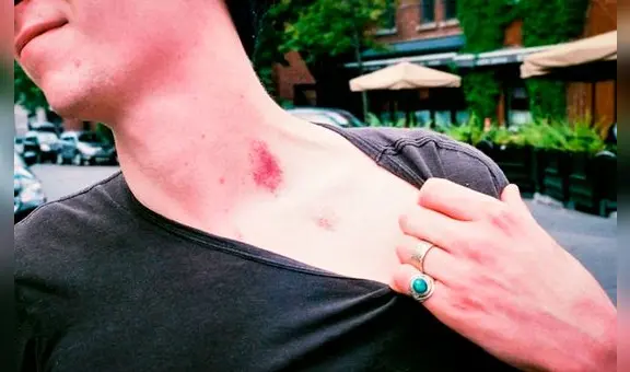 La historia del joven que murió luego de que su novia le causó un chupetón