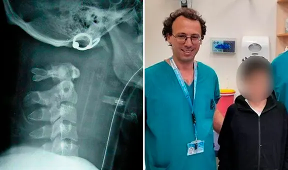 Médicos unen la cabeza al cuello de un niño que sufrió decapitación interna tras accidente