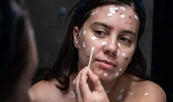 ¿Es cierto que la varicela en adultos es más grave que en los niños? EsSalud responde