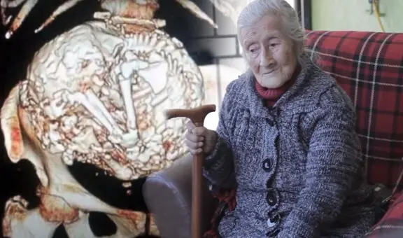 Estela Meléndez, la anciana que tuvo por más de 60 años un feto momificado dentro de su cuerpo