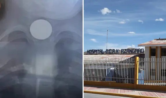 Niño de 4 años que ingirió moneda de S/1 se salva de morir tras ser sometido a cirugía en Puno