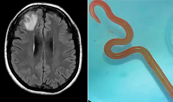 Médicos hallan un gusano vivo de 8 cm en el cerebro de una mujer en Australia