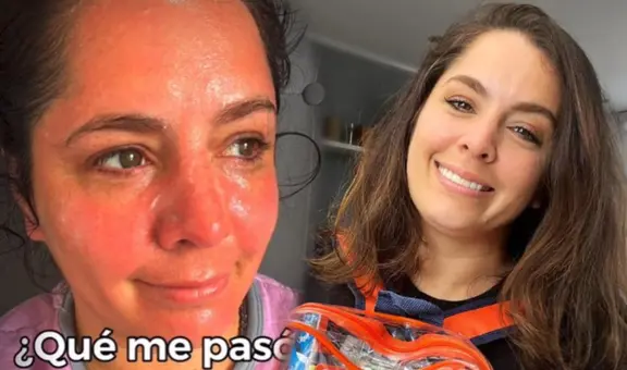 ¡Delicado! Yiddá Eslava sufre quemadura y preocupa a sus seguidores: ¿qué le pasó?