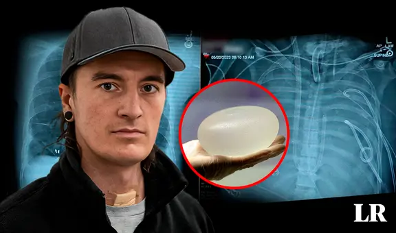 Hombre que fumaba mucho recibe implantes mamarios para salvar su vida de enfermedad terminal